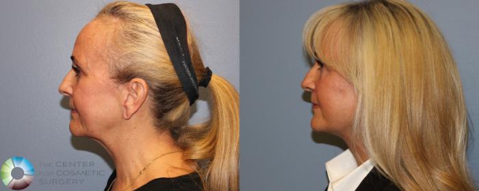 Before & After Mini Facelift Case 11297 Left Side View in Golden, CO