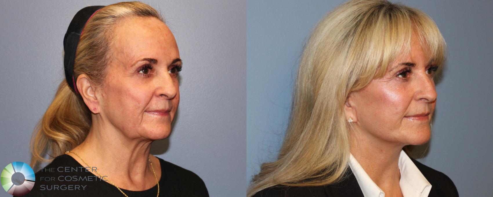 Before & After Mini Facelift Case 11297 Right Oblique in Denver and Colorado Springs, CO