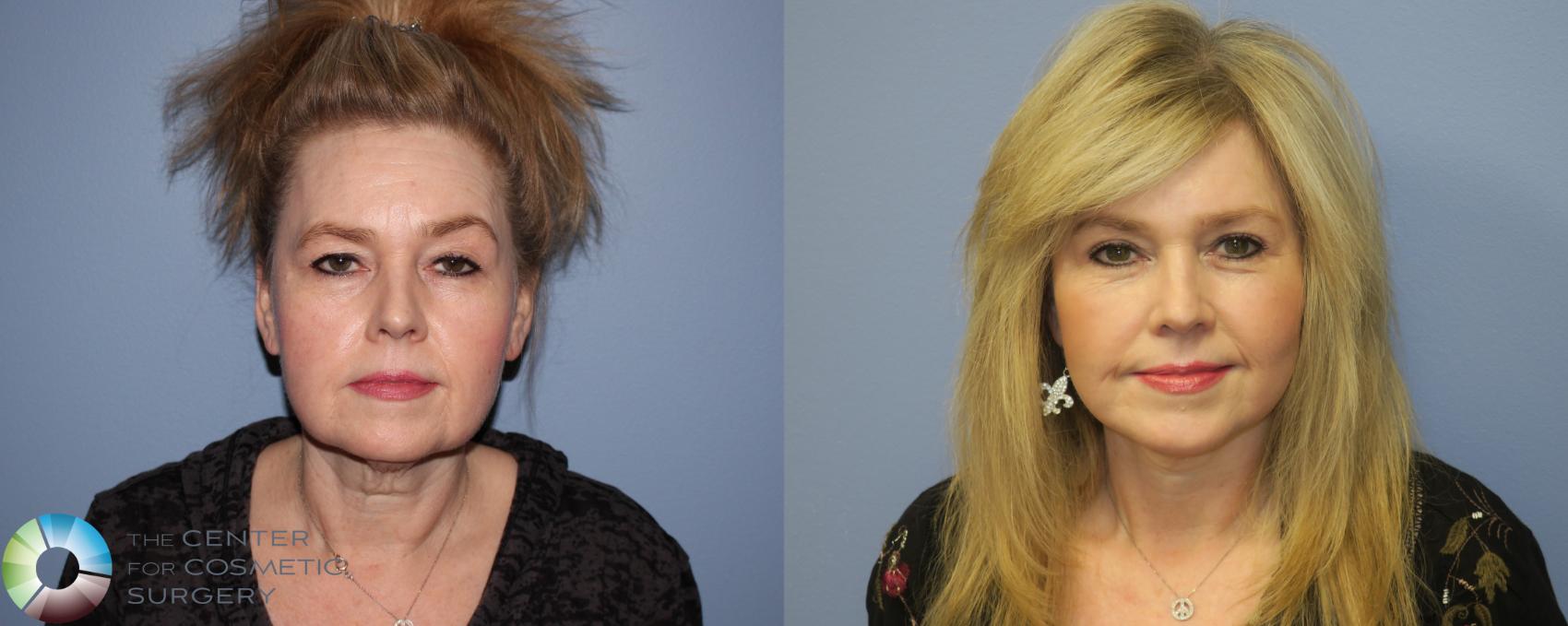 Before & After Facelift Case 11298 Front in Denver and Colorado Springs, CO