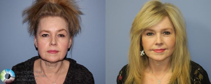 Before & After Mini Facelift Case 11298 Front View in Golden, CO