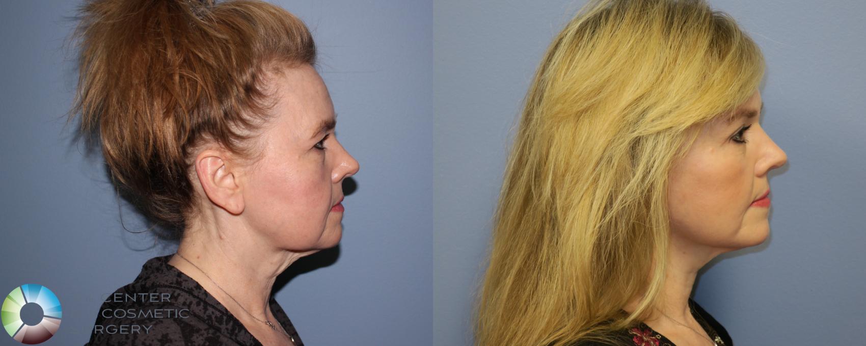 Before & After Mini Facelift Case 11298 Right Side View in Denver & Golden, CO