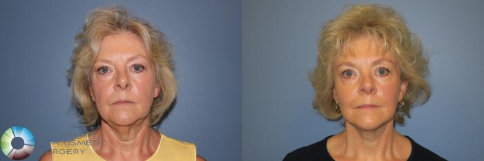 Before & After Mini Facelift Case 11332 Front View in Golden, CO