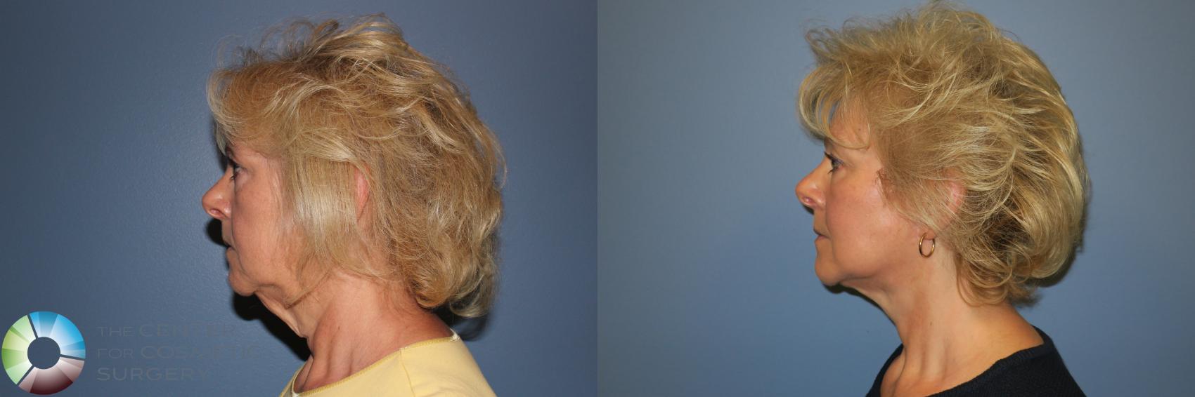 Before & After Mini Facelift Case 11332 Left Side in Denver and Colorado Springs, CO