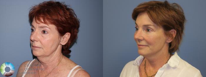 Before & After Eyelid Lift Case 11449 Left Oblique View in Golden, CO