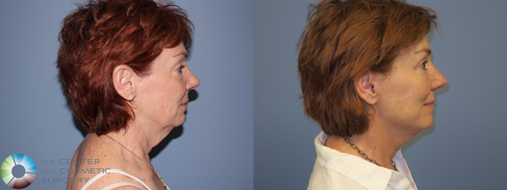 Before & After Mini Facelift Case 11449 Right Side View in Denver & Golden, CO