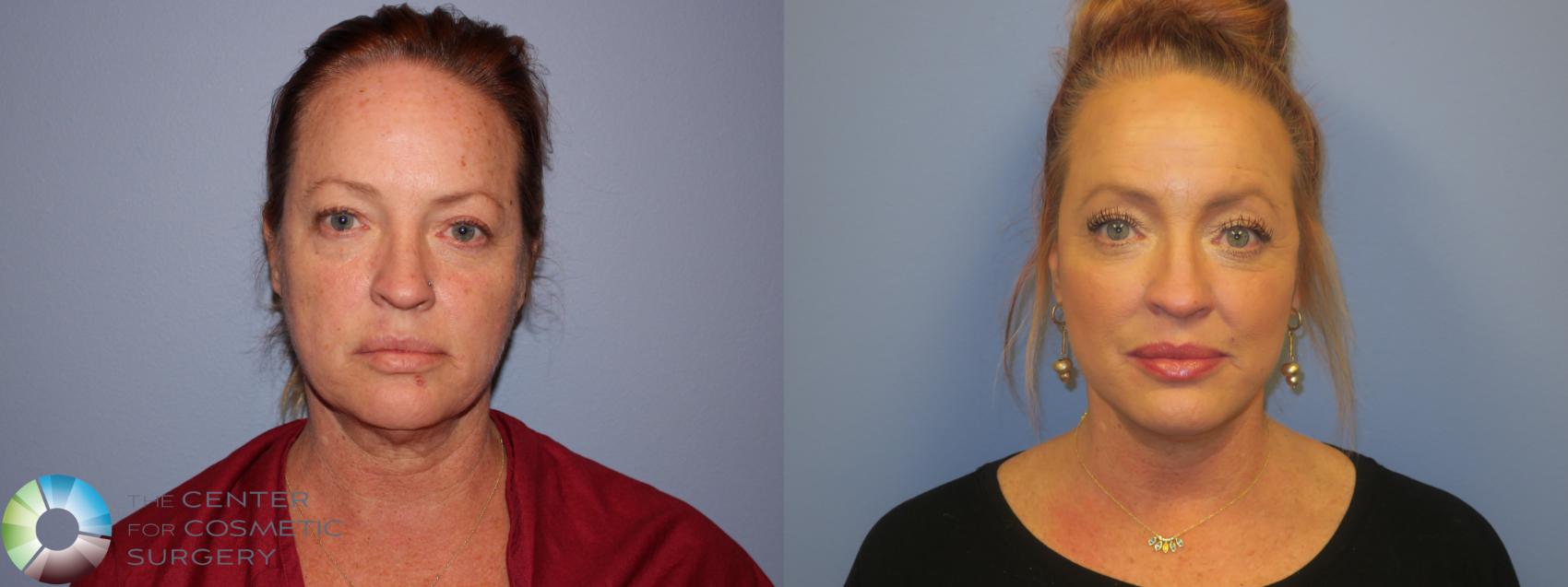 Before & After Neck Lift Case 11450 Front View in Denver & Golden, CO