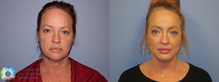 Before & After Neck Lift Case 11450 Front View in Golden, CO