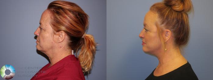 Before & After Neck Lift Case 11450 Left Side View in Golden, CO