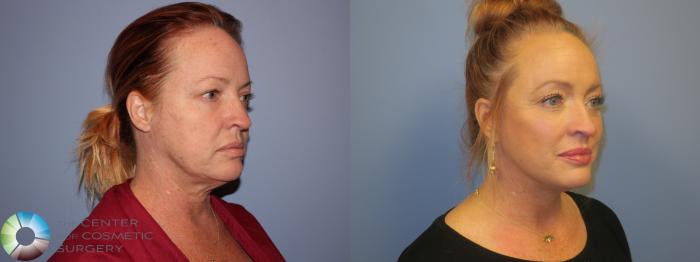 Before & After Neck Lift Case 11450 Right Oblique View in Golden, CO