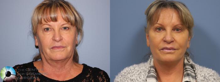 Before & After Mini Brow Lift Case 11451 Front View in Golden, CO