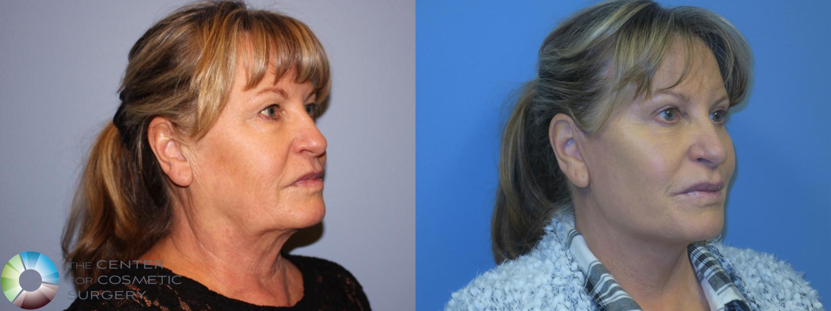 Before & After Mini Facelift Case 11451 Right Oblique in Denver and Colorado Springs, CO