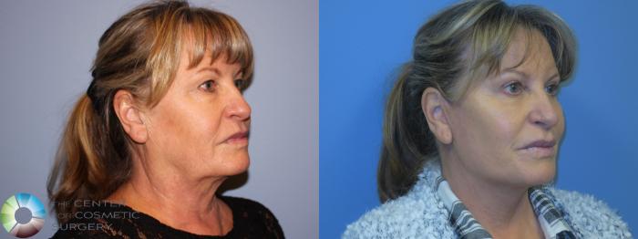 Before & After Mini Facelift Case 11451 Right Oblique View in Golden, CO