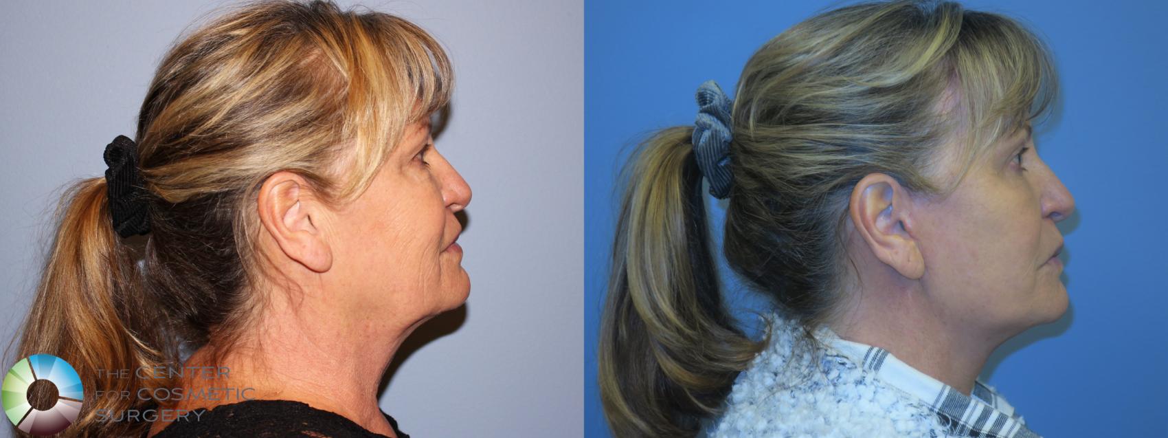 Before & After Mini Facelift Case 11451 Right Side in Denver and Colorado Springs, CO