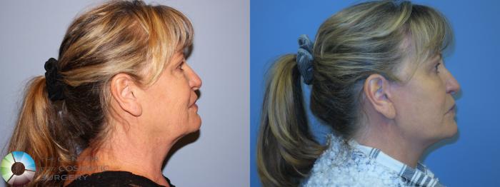 Before & After Mini Facelift Case 11451 Right Side View in Golden, CO
