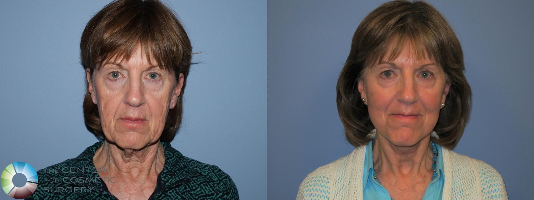 Before & After Mini Facelift Case 11452 Front in Denver, CO