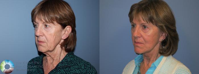 Before & After Neck Lift Case 11452 Left Oblique View in Golden, CO