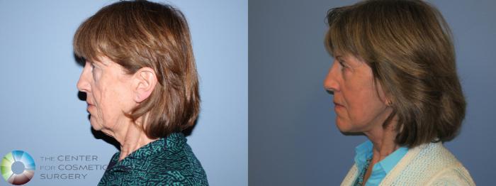 Before & After Neck Lift Case 11452 Left Side View in Golden, CO