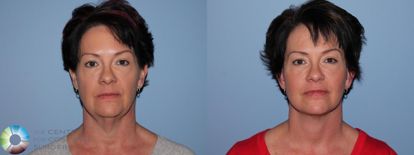 Before & After Mini Facelift Case 11453 Front View in Golden, CO