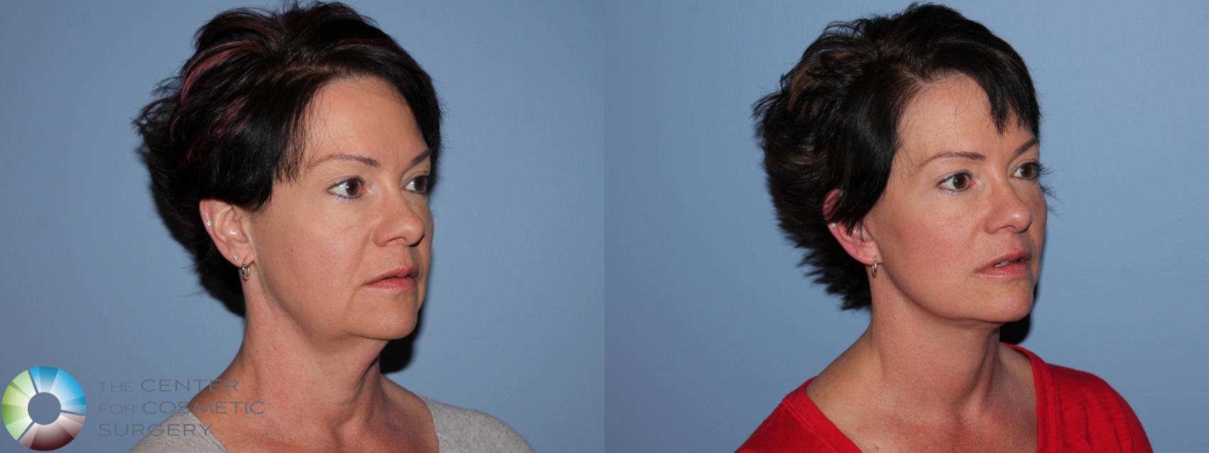 Before & After Mini Facelift Case 11453 Right Oblique View in Golden, CO