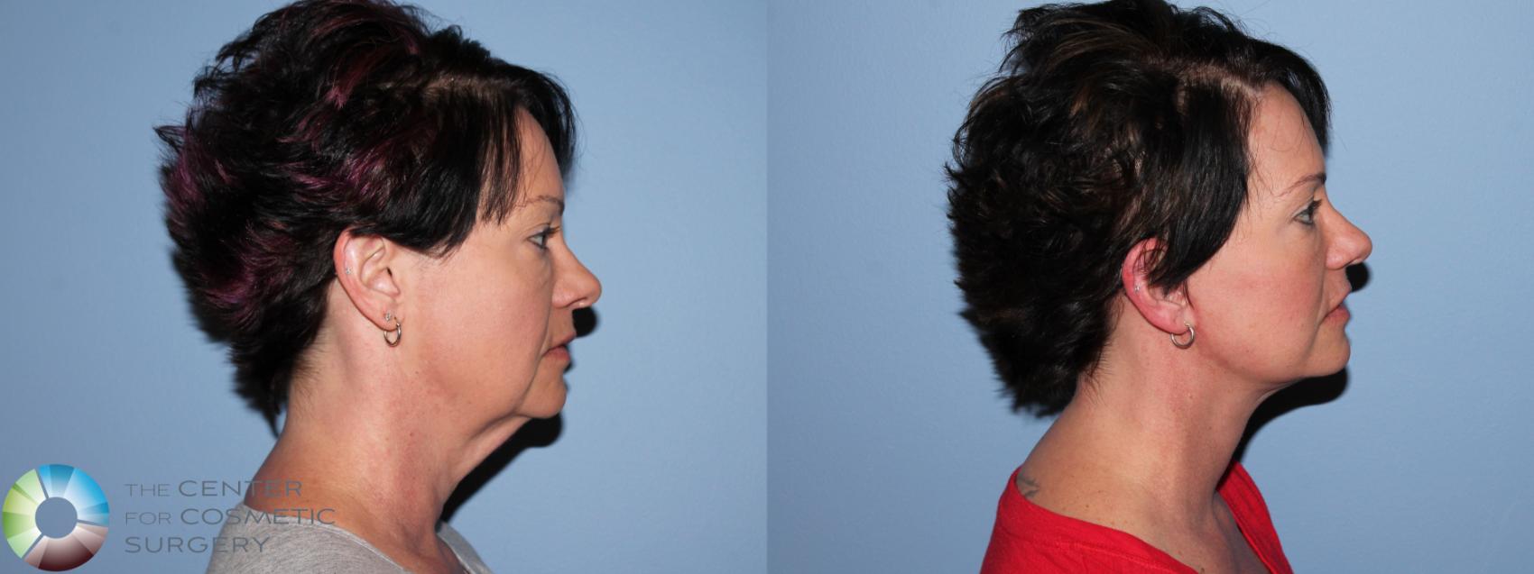 Before & After Mini Facelift Case 11453 Right Side View in Golden, CO