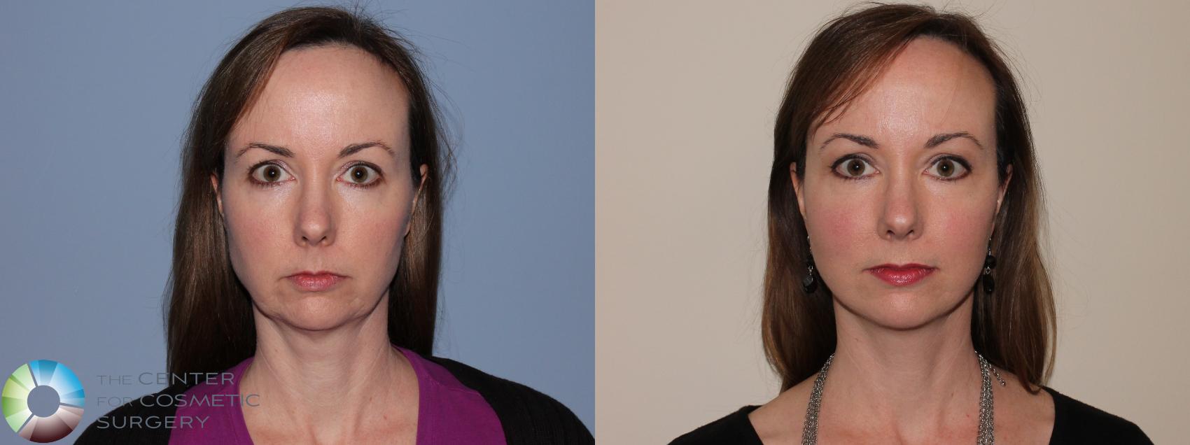 Before & After Mini Facelift Case 11462 Front in Denver and Colorado Springs, CO