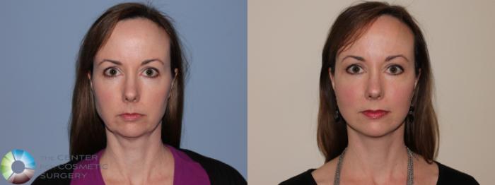 Before & After Neck Lift Case 11462 Front View in Golden, CO