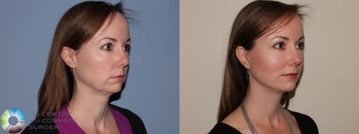 Before & After Neck Lift Case 11462 Right Oblique View in Golden, CO