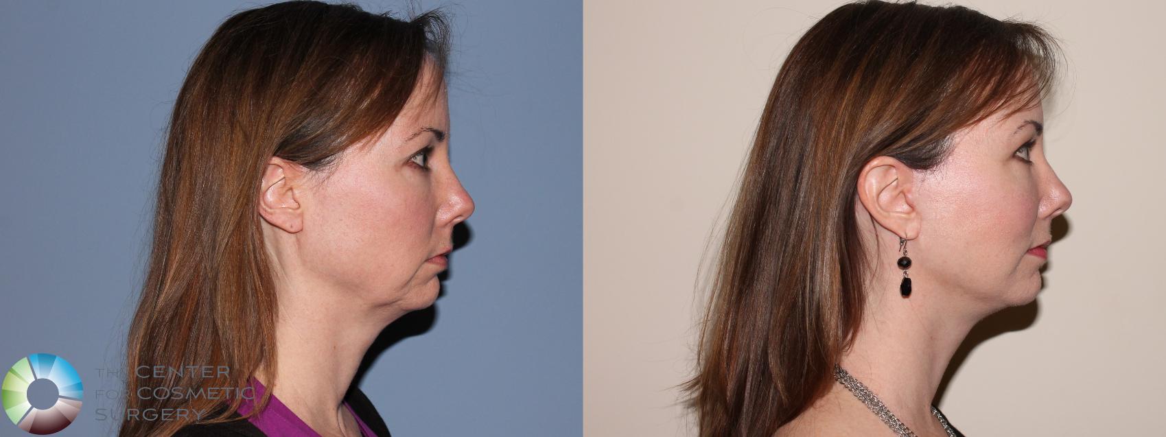 Before & After Mini Facelift Case 11462 Right Side View in Denver & Golden, CO