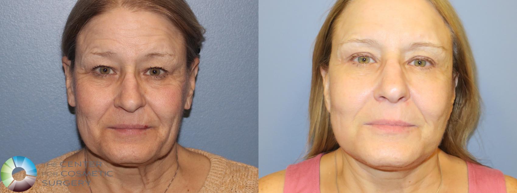 Before & After Mini Facelift Case 11481 Front in Denver and Colorado Springs, CO