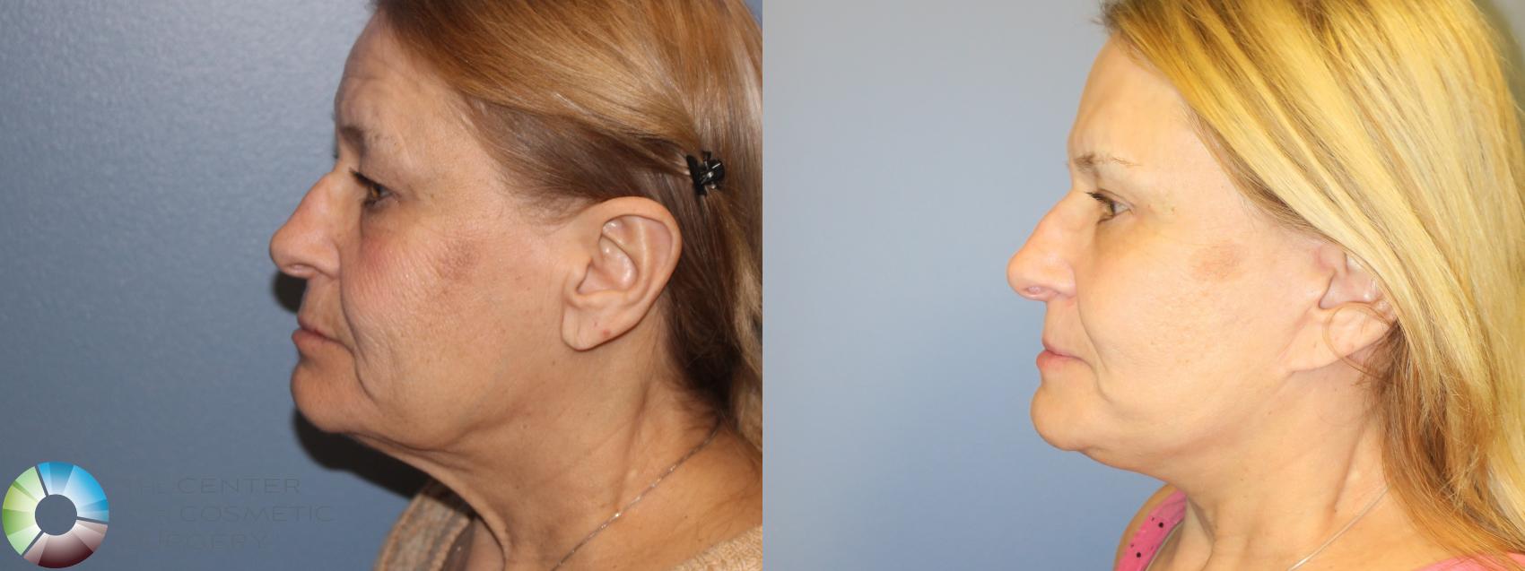 Before & After Mini Facelift Case 11481 Left Side in Denver and Colorado Springs, CO