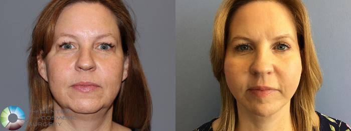 Before & After Mini Facelift Case 11482 Front in Denver and Colorado Springs, CO