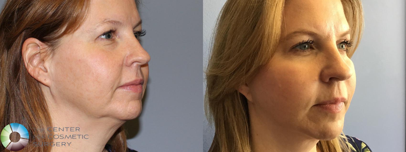 Best Denver Facelift Necklift Eyelid Lift
