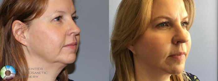 Before & After Mini Facelift Case 11482 Right Oblique in Denver and Colorado Springs, CO