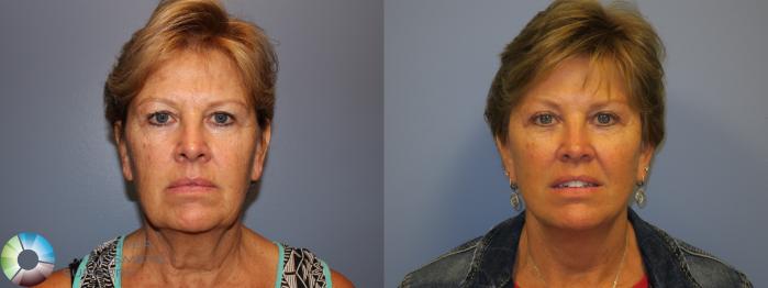 Before & After Mini Facelift Case 11485 Front View in Golden, CO