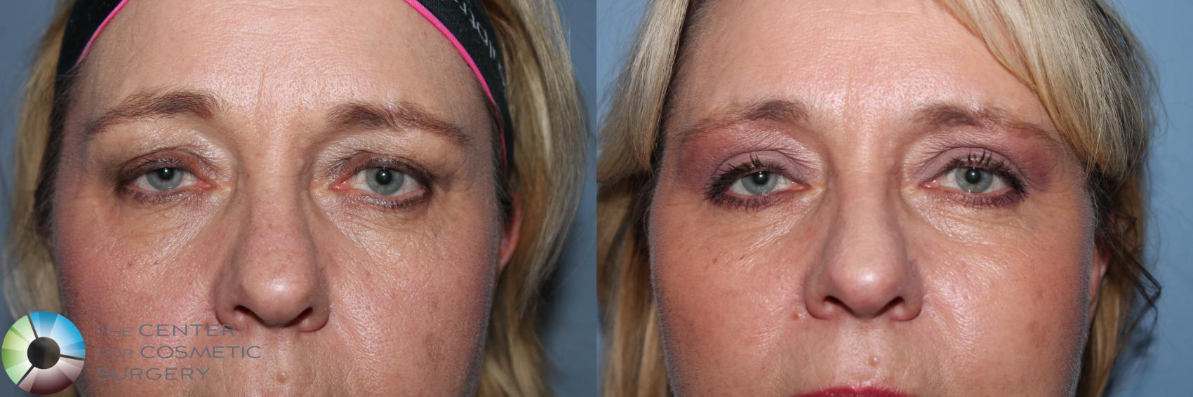 Before & After Mini Facelift Case 11495 Close-Up Eyes View in Golden, CO