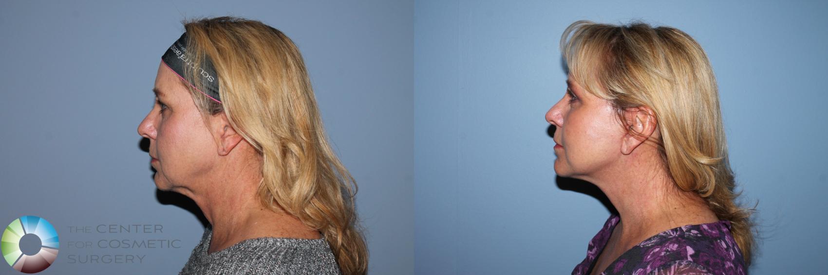 Before & After Mini Facelift Case 11495 Left Side View in Golden, CO