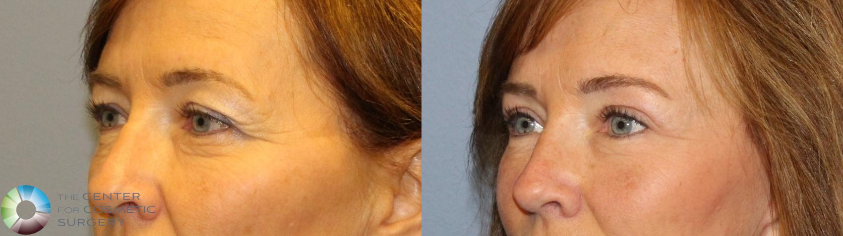 Before & After Neck Lift Case 11496 brow eyes oblique View in Denver & Golden, CO