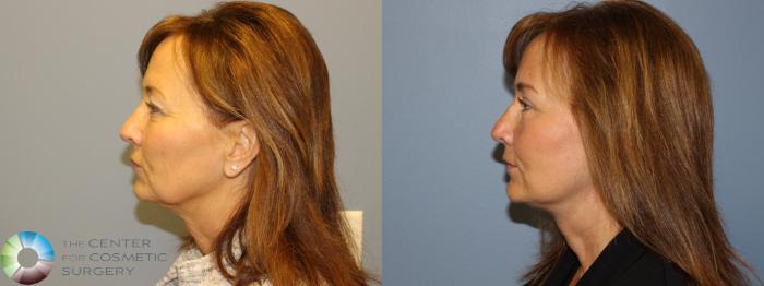 Before & After Mini Facelift Case 11496 Left Side View in Golden, CO