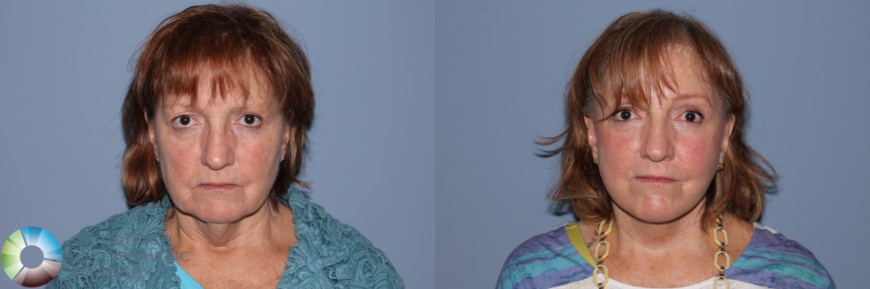 Before & After Mini Facelift Case 11526 Front in Denver and Colorado Springs, CO