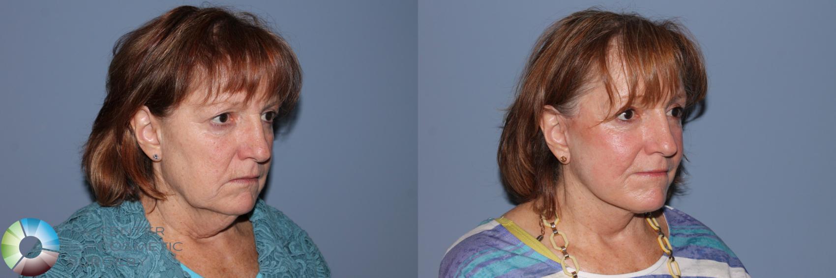 Before & After Mini Facelift Case 11526 Right Oblique View in Golden, CO