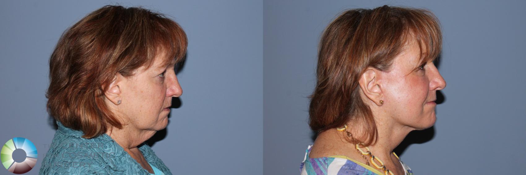 Before & After Mini Facelift Case 11526 Right Side View in Golden, CO