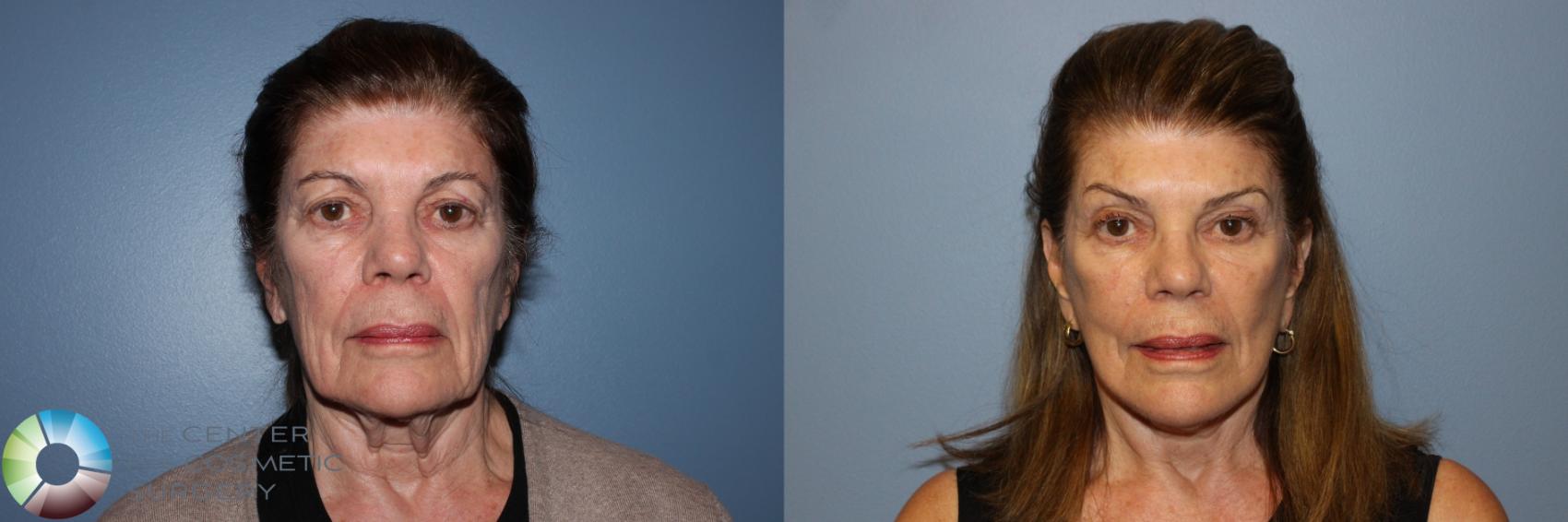 Before & After Mini Facelift Case 11529 Front View in Golden, CO