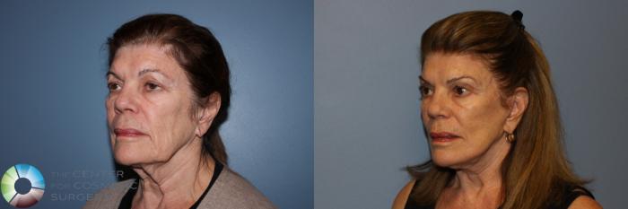 Before & After Mini Facelift Case 11529 Left Oblique View in Golden, CO