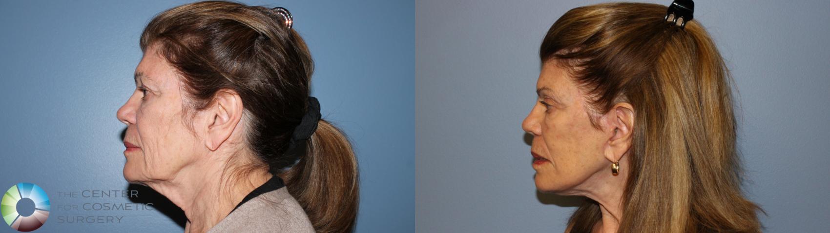 Before & After Mini Facelift Case 11529 Left Side View in Golden, CO