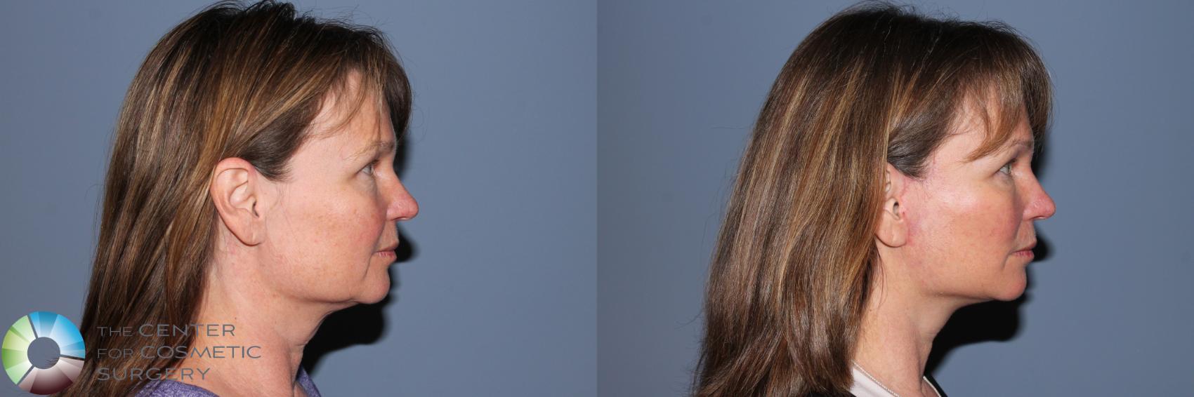 Before & After Mini Facelift Case 11553 Right Side View in Golden, CO