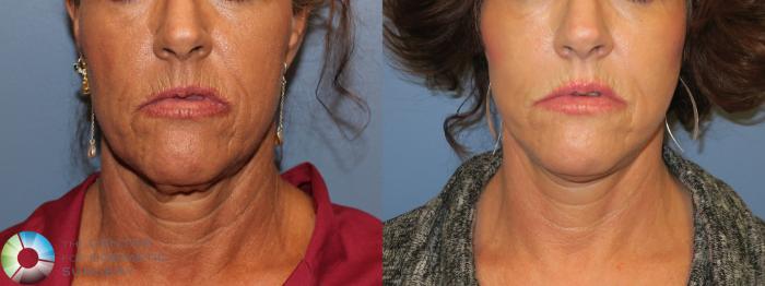 Before & After Neck Lift Case 11554 Front in Denver and Colorado Springs, CO