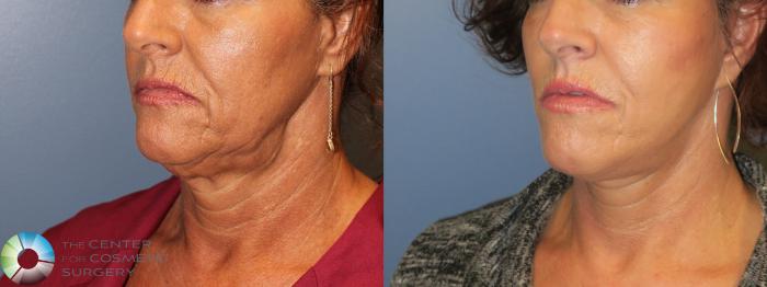 Before & After Neck Lift Case 11554 Left Oblique in Denver and Colorado Springs, CO