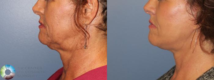 Before & After Neck Lift Case 11554 Left Side in Denver and Colorado Springs, CO