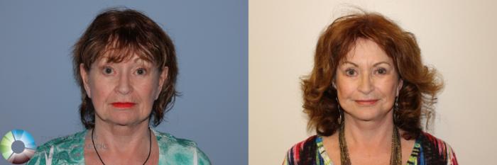 Before & After Mini Facelift Case 11562 Front in Denver and Colorado Springs, CO