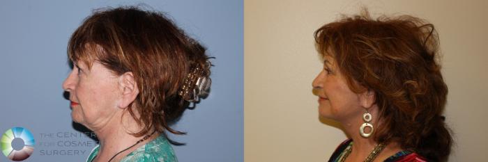 Before & After Mini Facelift Case 11562 Left Side in Denver and Colorado Springs, CO
